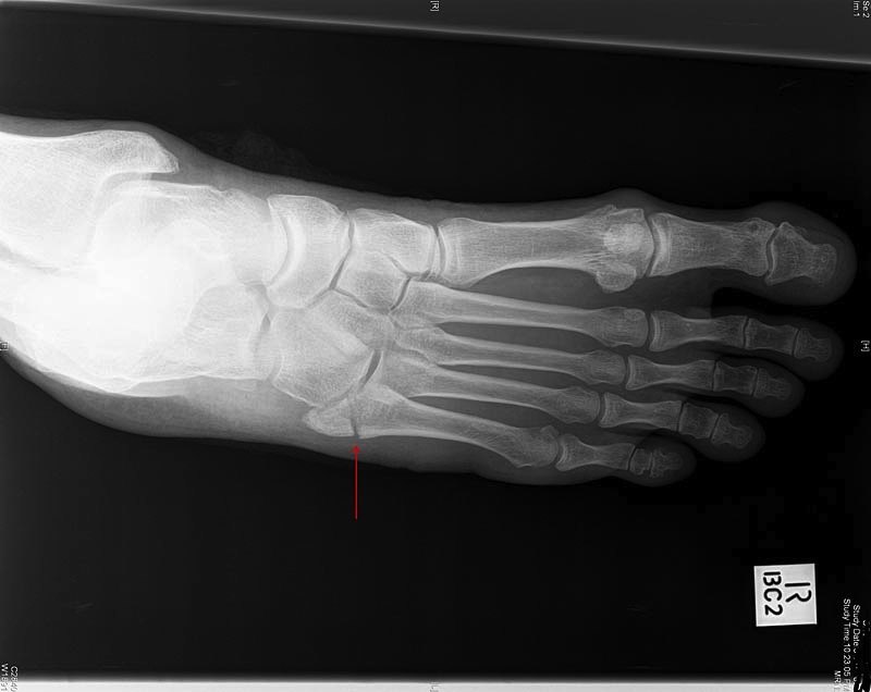 Worst foot. Get it? (Avulsion fracture, 5th MT)
